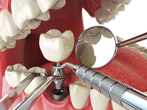 Best Emergency Treatment for Dental Infections or Abscesses in Ladysmith, WI